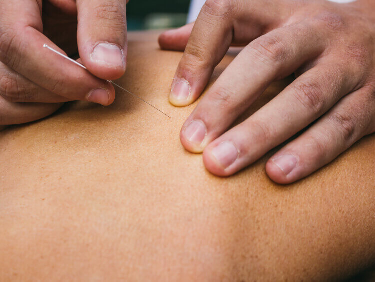 Acupuncture